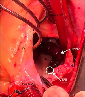 Mediante atriotomía derecha se visualiza trombo filiforme en tránsito a través de FOP. AD: aurícula derecha; FOP: foramen oval permeable; VCI: vena cava inferior; VCS: vena cava superior; VD: ventrículo derecho.
