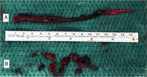 Visión macroscópica tras trombectomía de trombo atrapado en FOP (A) y trombos distales en arterias lobares (B). FOP: foramen oval permeable.