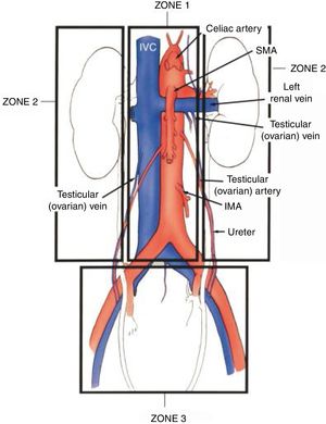 Reparaciones primarias aortoiliaca bilateral.