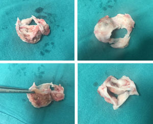 Válvula aórtica explantada en la primera intervención. Era trivalva, pero displásica, con material de aspecto necrótico en su interior.