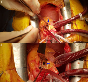 Imagen intraoperatoria. 1 y 2) Orificio fistuloso sobre el seno de Valsalva no coronario.