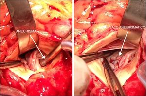 Después de la aortotomía, en la imagen de la izquierda vemos la pinza que atraviesa el aneurisma del seno no coronario. En la imagen de la derecha vemos el saco aneurismático por debajo de la válvula aórtica en el ventrículo izquierdo.