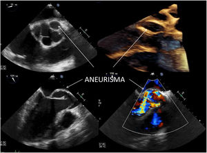 Ecocardiograma transtorácico y transesofágico en 3D; se observan, en diferentes cortes, los aneurismas.