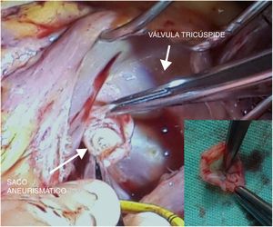 El saco aneurismático protruye en la aurícula derecha; la imagen pequeña en el cuadrante inferior derecho es el saco después de ser resecado.
