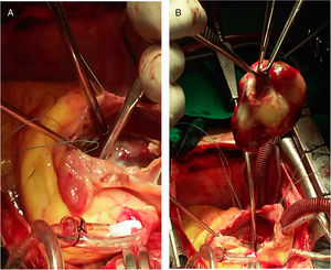 Procedimiento quirúrgico en el caso #2. A) Apertura del SIA y exposición del mixoma. B) Mixoma totalmente resecado de la AI, sostenido por pinzas en su base de implantación.
