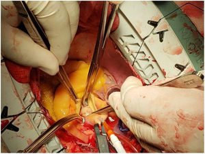 Resección del mixoma. Cirugía con abordaje por esternotomía media.