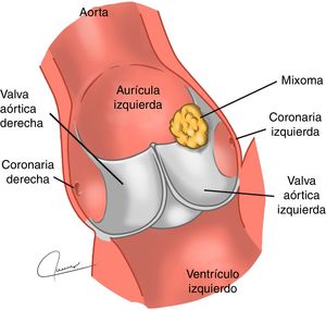 Esquema de localización del mixoma. Tumor localizado entre la valva posterior no coronariana y la coronariana izquierda.