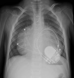 Radiografía de tórax posteroanterior. Cardiomegalia con predominio de aumento de cavidades derechas. Sistema de marcapasos DDD epicárdico normoposicionado.
