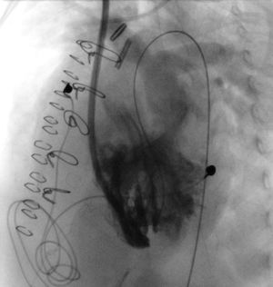 Implante de dispositivo Amplatzer para cierre de comunicación interventricular de la punta.