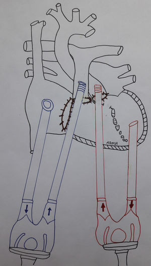Esquema de implante del Berlin-Heart® doble del caso 2. Se han retirado el Amplatzer y el parche de cierre de la comunicación interventricular grande subaórtica. Se han cerrado con parches de pericardio los anillos valvulares tricúspide, aórtico y pulmonar (este último tras el explante de la prótesis mecánica).