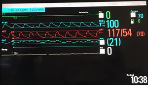 Pantalla de monitorización en la que se aprecia la curva de presión del Berlin-Heart®, la curva de pulsioximetría, la medida de presión venosa central y silencio eléctrico total en el electrocardiograma.