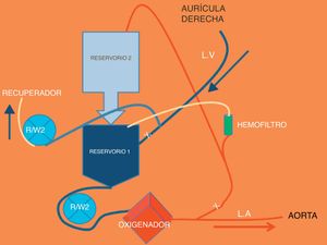 Esquema de circuito de circulación extracorpórea modificado para realizar exanguinotransfusiones durante un trasplante ABO incompatible.
