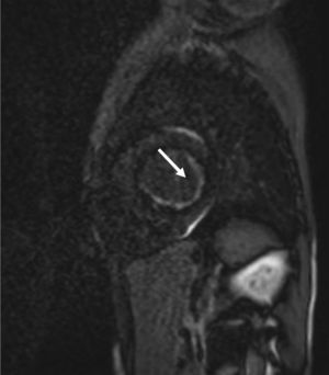 La RM muestra fibroelastosis endocárdica de ventrículo izquierdo.