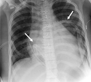 Asistencia del ventrículo derecho con Levitronix® CentriMag (Rx).