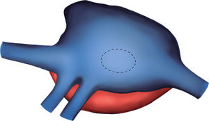 Esquema de la anatomía desde el tórax derecho. Obsérvense ambas venas pulmonares derechas drenando en la aurícula derecha.