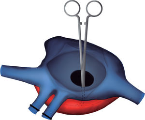 Esquema para localizar la mejor zona de anastomosis del casquete de las venas pulmonares derechas del donante. Se pasa un ángulo recto a través de la comunicación interauricular y se localiza la zona de la aurícula izquierda que se relaciona mejor con las venas del donante (línea punteada).