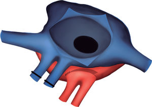 Esquema de la anastomosis entre el casquete de las venas pulmonares del donante y la aurícula izquierda del receptor.