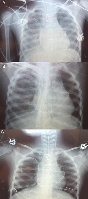 Evolución radiológica de la niña correspondiente al primer caso. Se observa radiografía de tórax: A)previa a la implantación de ECMO, B)tras la implantación de ECMO y C)previa a la extubación una vez retirado el soporte.