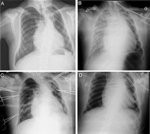 Evolución radiológica en el segundo caso clínico. Se observa radiografía de tórax: A)a la llegada de quirófano, con progresivo empeoramiento a lo largo de la tarde, B)previa a la implantación de ECMO, C)tras la implantación de ECMO y D)previa a la extubación una vez retirado el soporte.