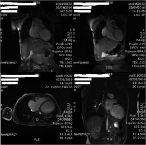 Imágenes de la cardio-RMN practicada a los 10 años de edad donde se aprecia la importante dilatación del VI. En esta exploración complementaria, la fracción de eyección del VI se estimó en un 18%.