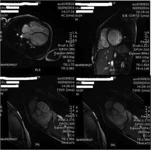 Imágenes de la cardio-RMN practicada a los 10 años de edad donde se aprecia la dilatación del VD. En esta exploración complementaria, la fracción de eyección del VD se estimó en un 34% y se cuantificó la insuficiencia valvular pulmonar como severa con una fracción regurgitante del 58%.