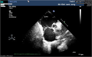 Ecocardiografía practicada al ingreso en la UCIP que muestra una severa dilatación del VD secundaria a la insuficiencia valvular pulmonar.