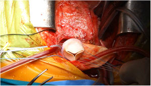 Detalle del implante de la bioprótesis pulmonar, procedimiento que se realizó previamente a la colocación de las cánulas de EXCOR® (Berlin Heart AG, Berlín, Alemania).
