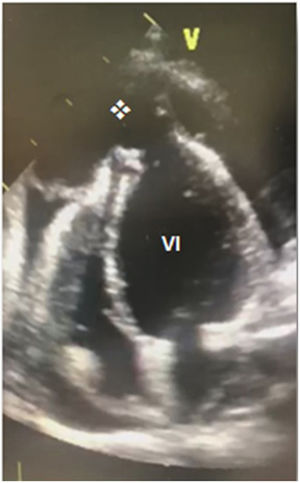 Ecocardiograma transtorácico con defecto (*) en pared de ventrículo izquierdo (VI).