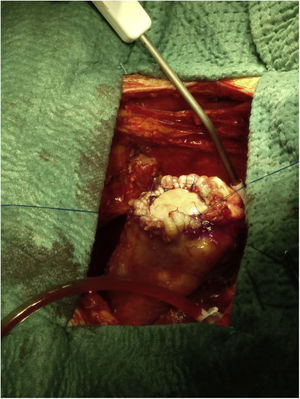 Reparación de pseudoaneurisma ventricular tras resección: parche de pericardio suturado con puntos sueltos de monofilamento y sutura circular de refuerzo. Sobre la superficie aplicamos hemostático local (bioglue).