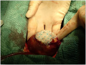 Resultado final de reparación de pseudoaneurisma ventricular con hemopatch, aplicado sobre la superficie del parche de pericardio y bioglue.