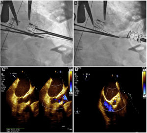 A y B. Captura y extracción de la prótesis embozada con pinza de laparoscopia. C y D. Resultado final con prótesis normofuncionante sin complicaciones asociadas.