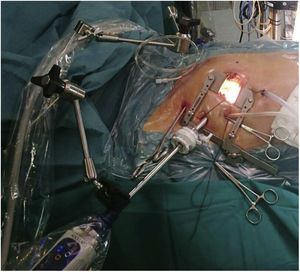 Campo quirúrgico tras minitoracotomía de 6 cm y colocación de trócar y cámara 3D.