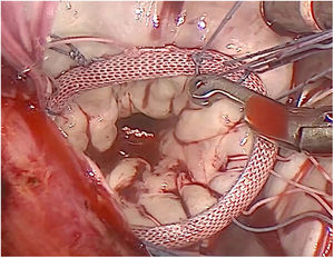 Se aprecia anillo mitral durante anudamiento con bajanudos tras colocación de 2 neocuerdas en velo posterior.