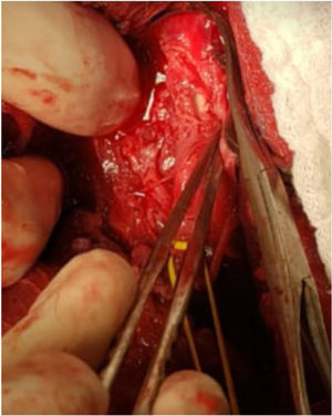 Lesión de un 30% de circunferencia en la arteria carótida común derecha.