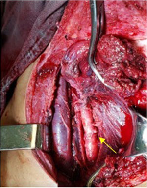 Disección del paquete neurovascular cervical; se muestra posteriormente a la reparación con anastomosis término-terminal (amarillo).