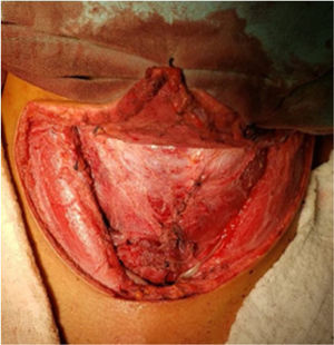 Reconstrucción de músculos pretiroideos antes del cierre de la cervicotomía.