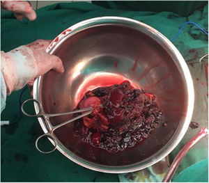 Imagen intraoperatoria. Pieza quirúrgica donde se evidencia destrucción del parénquima renal, acompañado de coágulos.