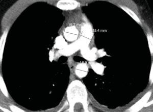 Angiotomografía computarizada. Proyección axial. Se aprecia aorta y arteria pulmonar de reducido tamaño.