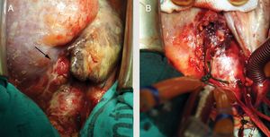 Vista intraoperatoria del corazón desde posición craneal una vez abierto el pericardio. A) Hematoma sobre la cara anterior de la aorta ascendente y grasa epicárdica del ventrículo derecho (flecha). B) Material necrótico y purulento observado al desbridar el hematoma.