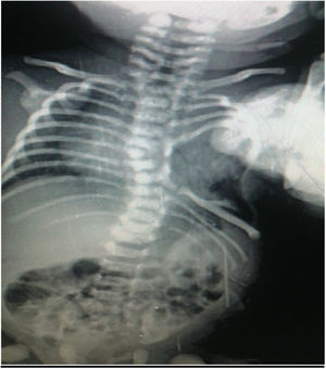Plain Chest X-ray showing absent 5th–8th ribs on left side.