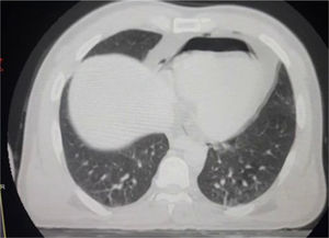 CT chest showing pneumopericardium.