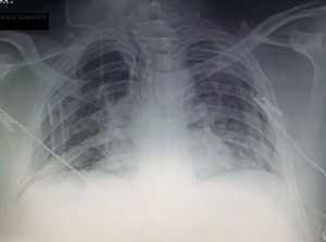 Follow up chest X-ray with bilateral chest tubes.