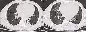 Follow up CT chest showing resolve of pneumopericardium.