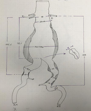 Planeación manual preoperatoria evaluando los diámetros de toda la aorta y la anatomía del cuello aórtico.