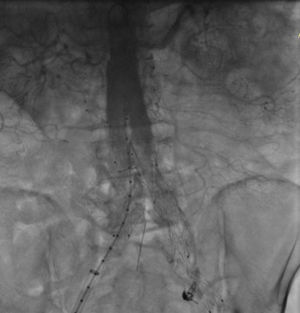 Imagen del aortograma con el resultado final de la colocación de la endoprótesis. A nivel de las arterias ilíacas se ven los módulos pequeños de la endoprótesis.