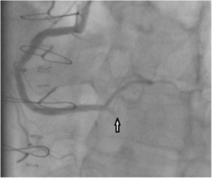 Coronariografía postoperatoria que muestra arteria descendente posterior amputada.