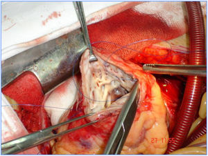 Apertura apical del ventrículo izquierdo.