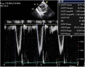 Doppler espectral pulsado a nivel de TSVI. Se puede observar la variabilidad durante los movimientos respiratorios del volumen sistólico a través de la VAo.