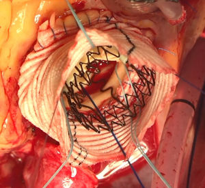 Implantación de prótesis Perceval y tubo supracoronario.