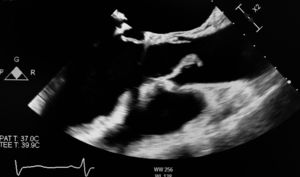 Imagen ecocardiográfica de verruga endocardítica sobre válvula aórtica.